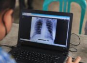 Deteksi Dini TBC di Kota Tangerang Melalui Active Case Finding