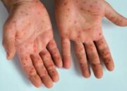 Wajib Tahu Gejala, Penularan, dan Cara Pencegahan Mpox