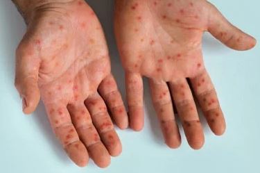 Wajib Tahu Gejala, Penularan, dan Cara Pencegahan Mpox